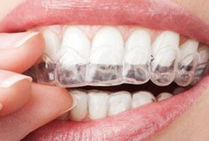 Elements Affecting The Performance Of Invisalign